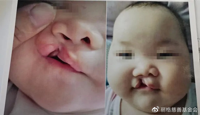 琪琪第一期唇腭裂術(shù)前照
